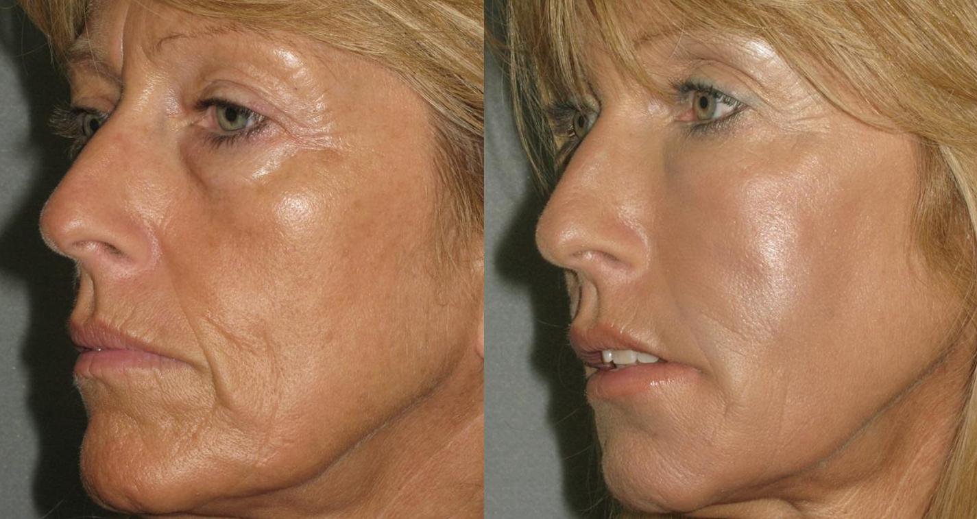 Arab Strip off Hover Lifting Facial Nechirurgical (Lichid) - Dr. Dana Bratu