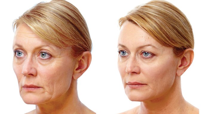 Lifting Facial - Pret si Recomandari | Dr. Eugen Turcu