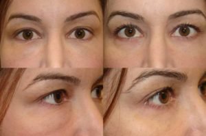 Umflare sub ochi după botox cauza, tratamentul și prevenirea