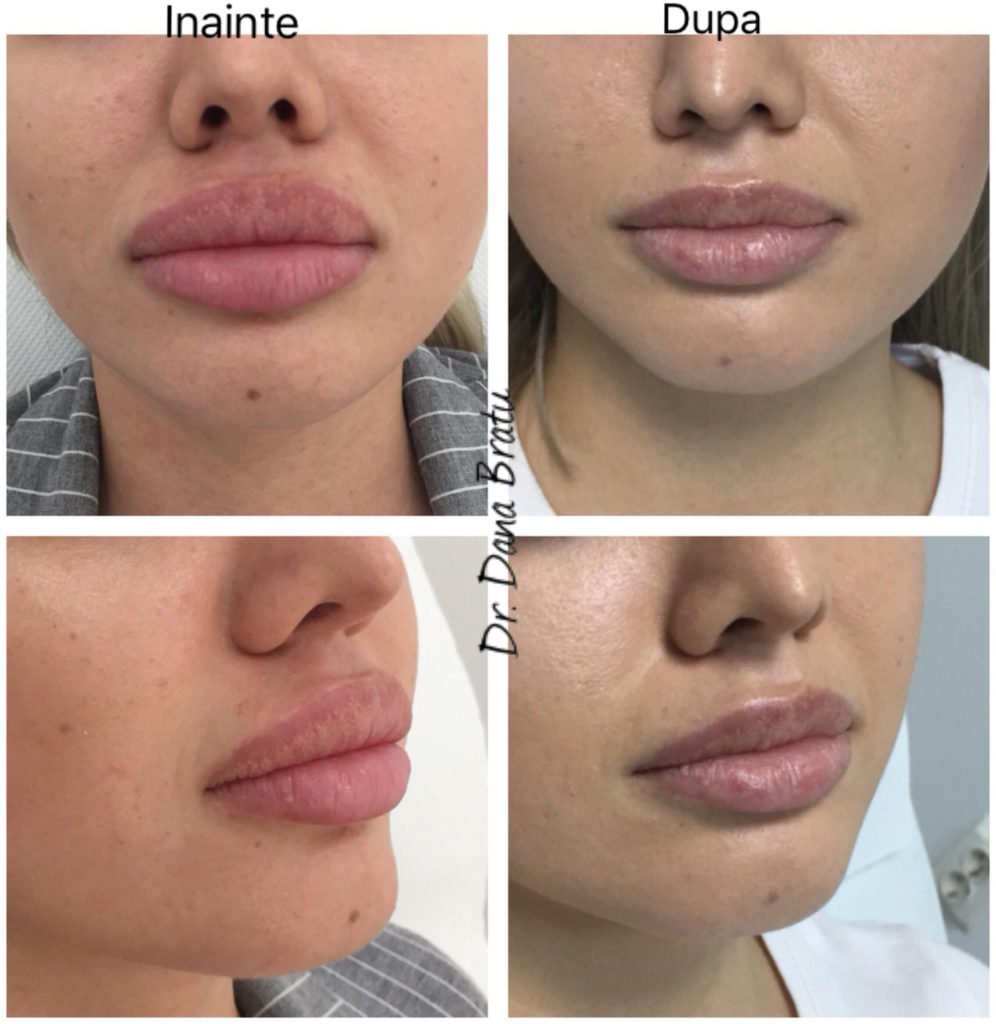 Augmentarea buzelor cu acid hialuronic - mărire buze | SKINOVATE