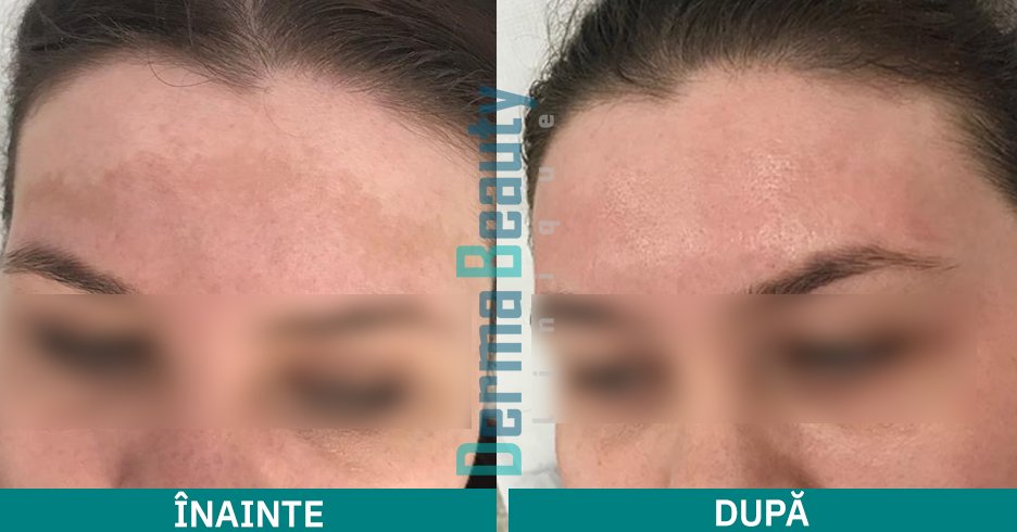 Tratament melasma
