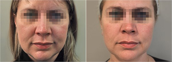 Tratament ProFhilo - Rejuvenare Faciala