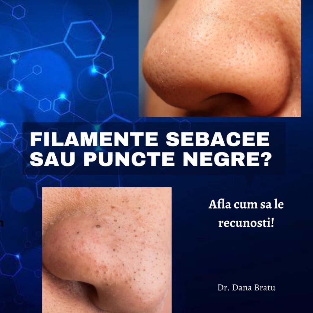 Filamente sebacee sau puncte negre