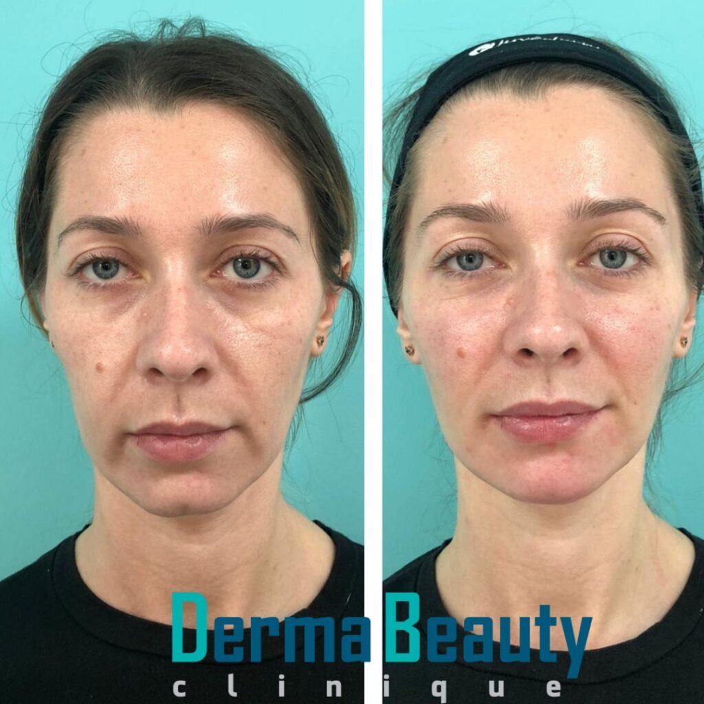 Lifting Facial Lichid Full Face